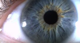 Чип, имплантиран в окото, помага на слепи да виждат